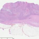 Case 3 Fig. 6 Hepatic flexure colon mass, initial colonic resection, LPO