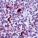 Loyola Case 5 FNA pap 20x